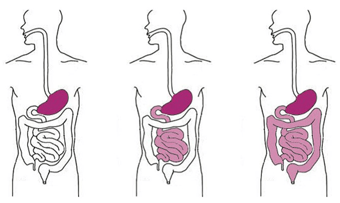 La prolifération bactérienne intestinale de l&rsquo;intestin grêle (SIBO)